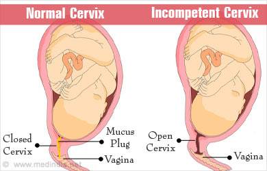 Hati-hati Incompetence Cervix, Berisiko Melahirkan Prematur
