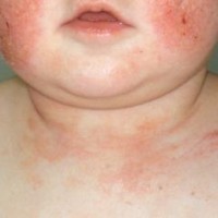 atopicDermatitisEczema_4129_lg