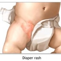 diaper-rash