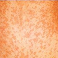 Campak, Rubella, dan Roseola (I)