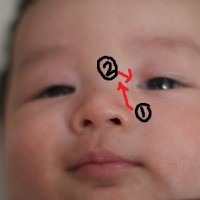 Belekan pada Mata Bayi