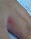 Hand, Foot and Mouth Disease II