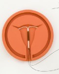Hamil Dengan IUD, Amankah?