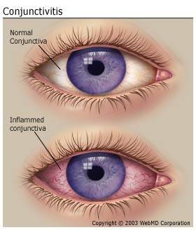 Radang Mata (Conjunctivitis)