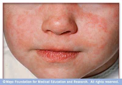 Campak, Rubella, dan Roseola (I)
