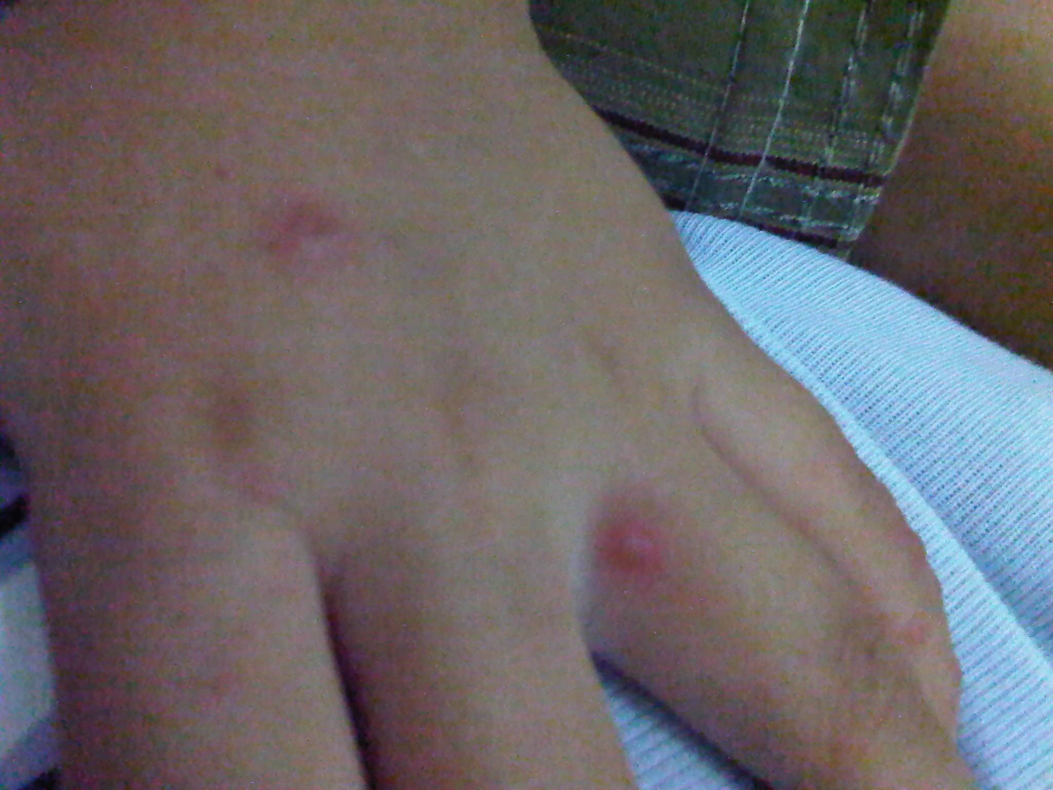 Hand, Foot and Mouth Disease II