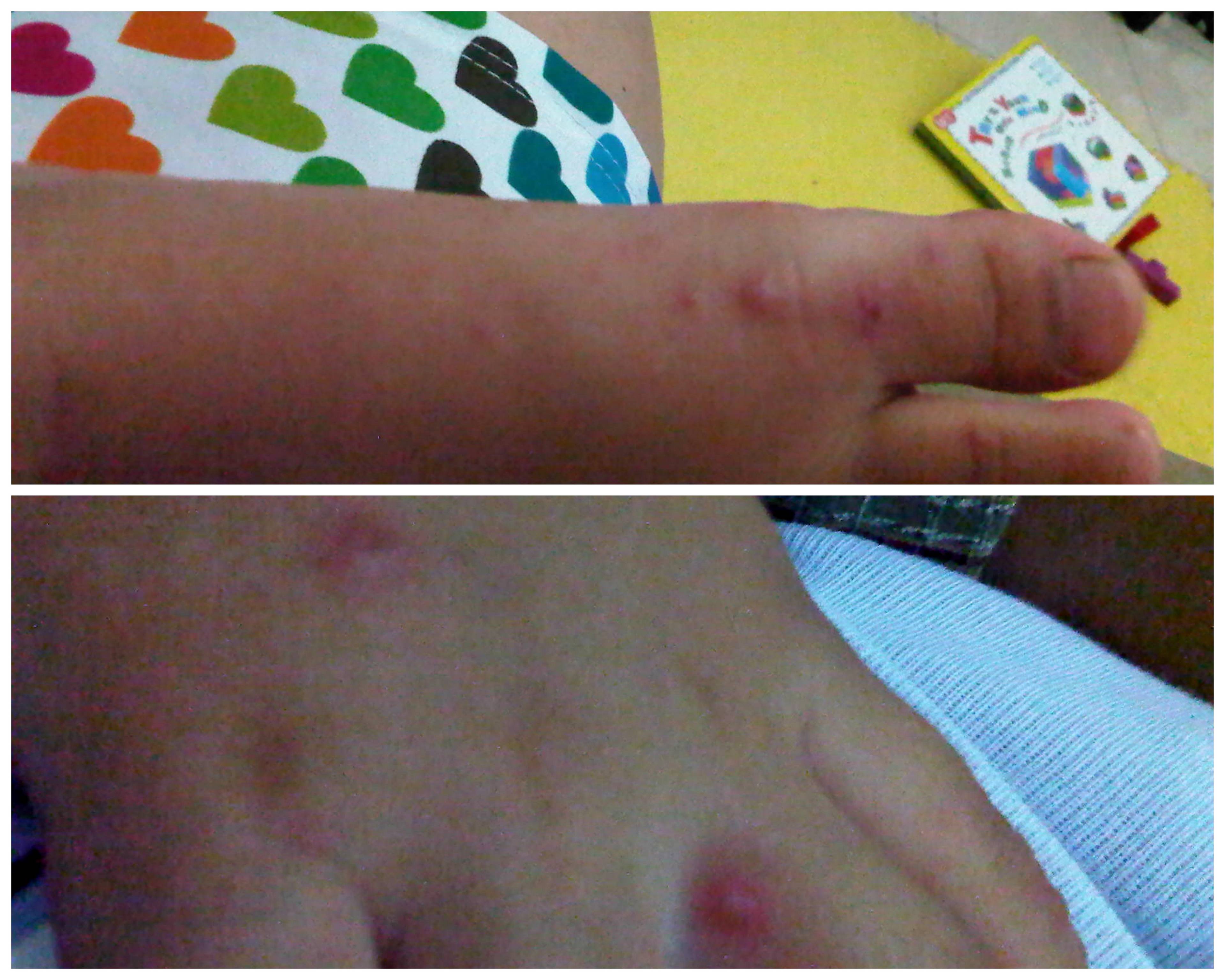 Hand, Foot, and Mouth Disease I