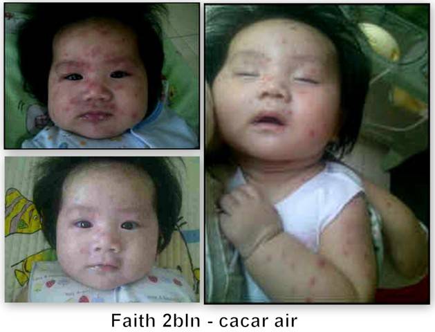 Menyusui dan Cacar Air
