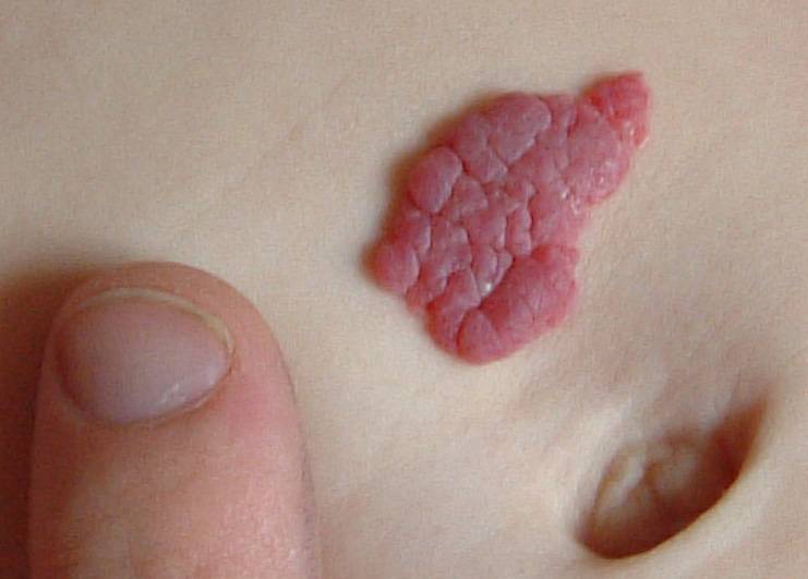 Hemangioma Pada Bayi Baru Lahir