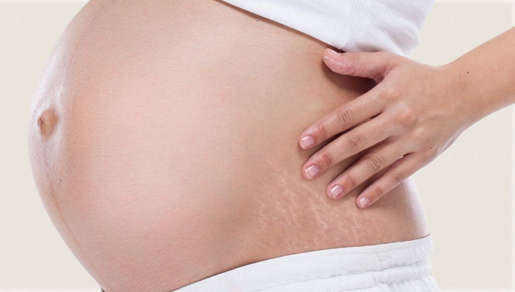 Cara Mencegah dan Menghilangkan Stretch Marks
