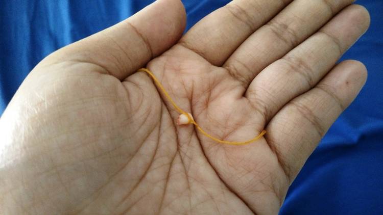 Boleh nggak, Mencabut Sendiri Gigi Susu Anak yang Goyang?
