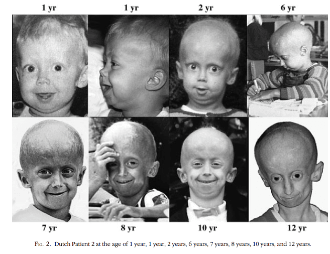 Kisah Benjamin Button, Juga Ada di Kehidupan Nyata