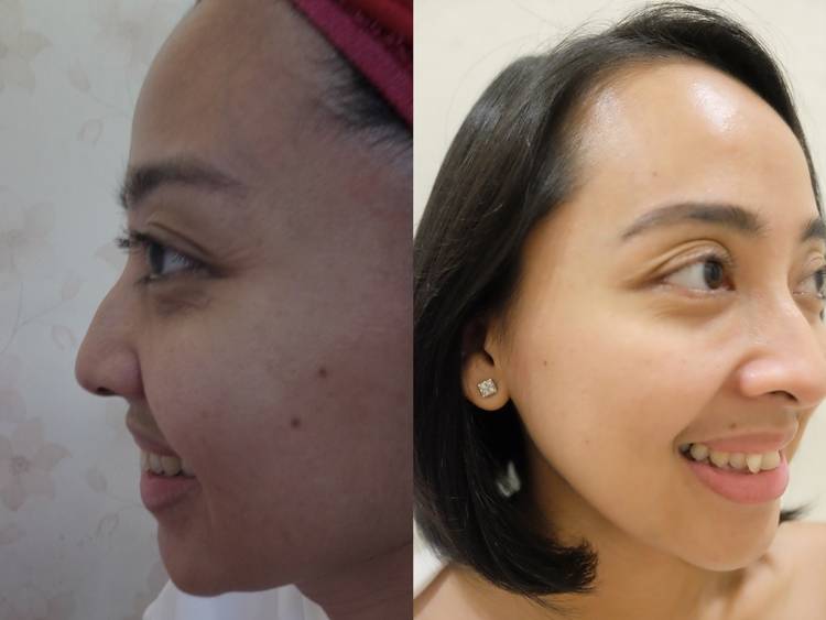 Selamat Tinggal Kerutan Mata Berkat Botox