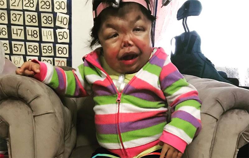 Mengenal Kelainan Langka Pfeiffer Syndrome, Apa Bisa Dicegah?