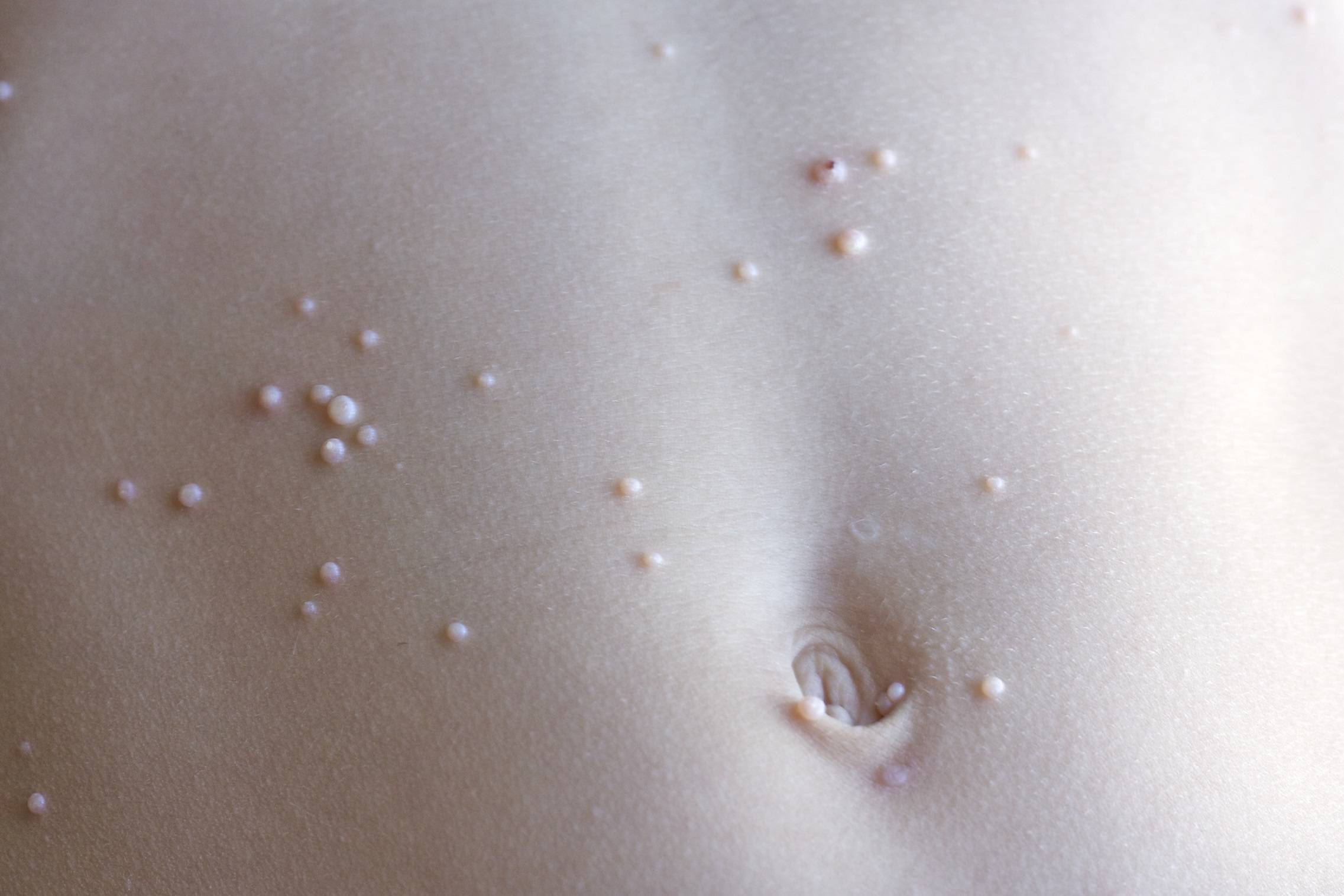 Sering Dikira Jerawat Batu, Yuk, Kenali Molluscum Contagiosum pada Balita
