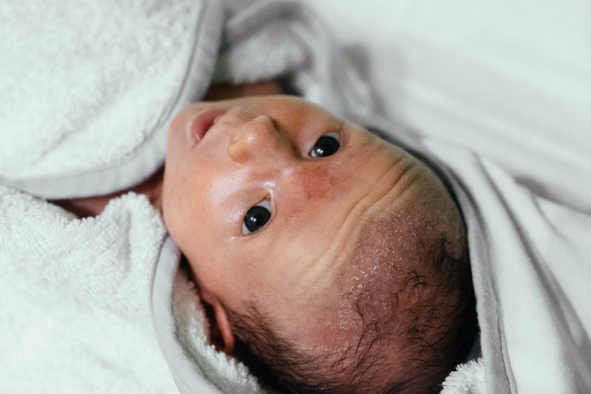Mengatasi Dermatitis Seboroik pada Kepala Bayi