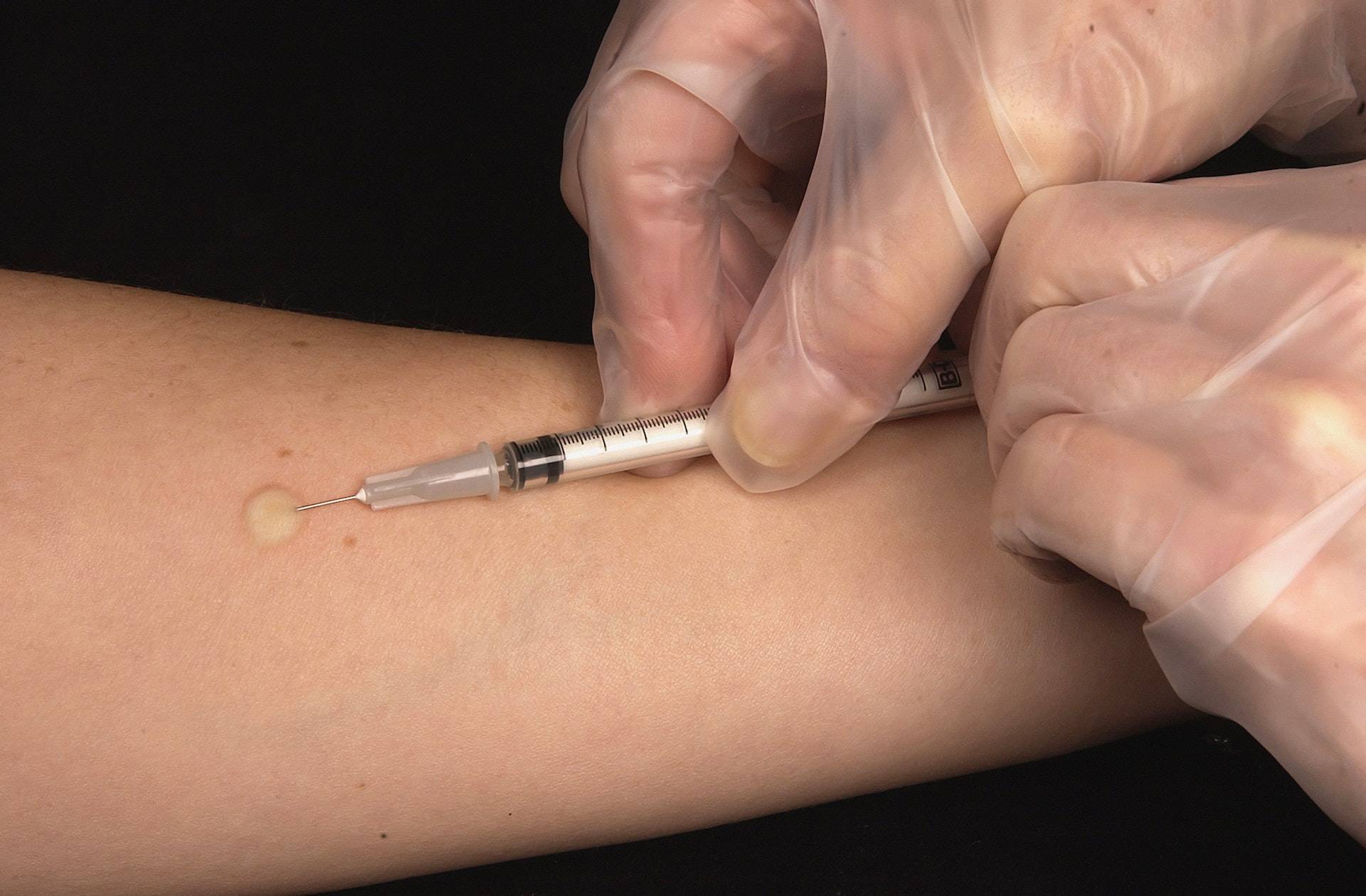 Serba-Serbi Tes Mantoux Pada Anak