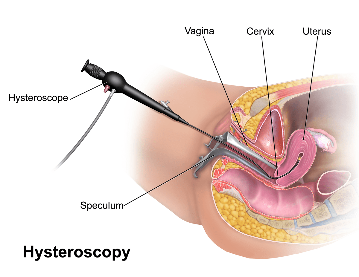 Mengenal Histeroskopi, Diagnosa Kelainan pada Rahim yang Minim Risiko
