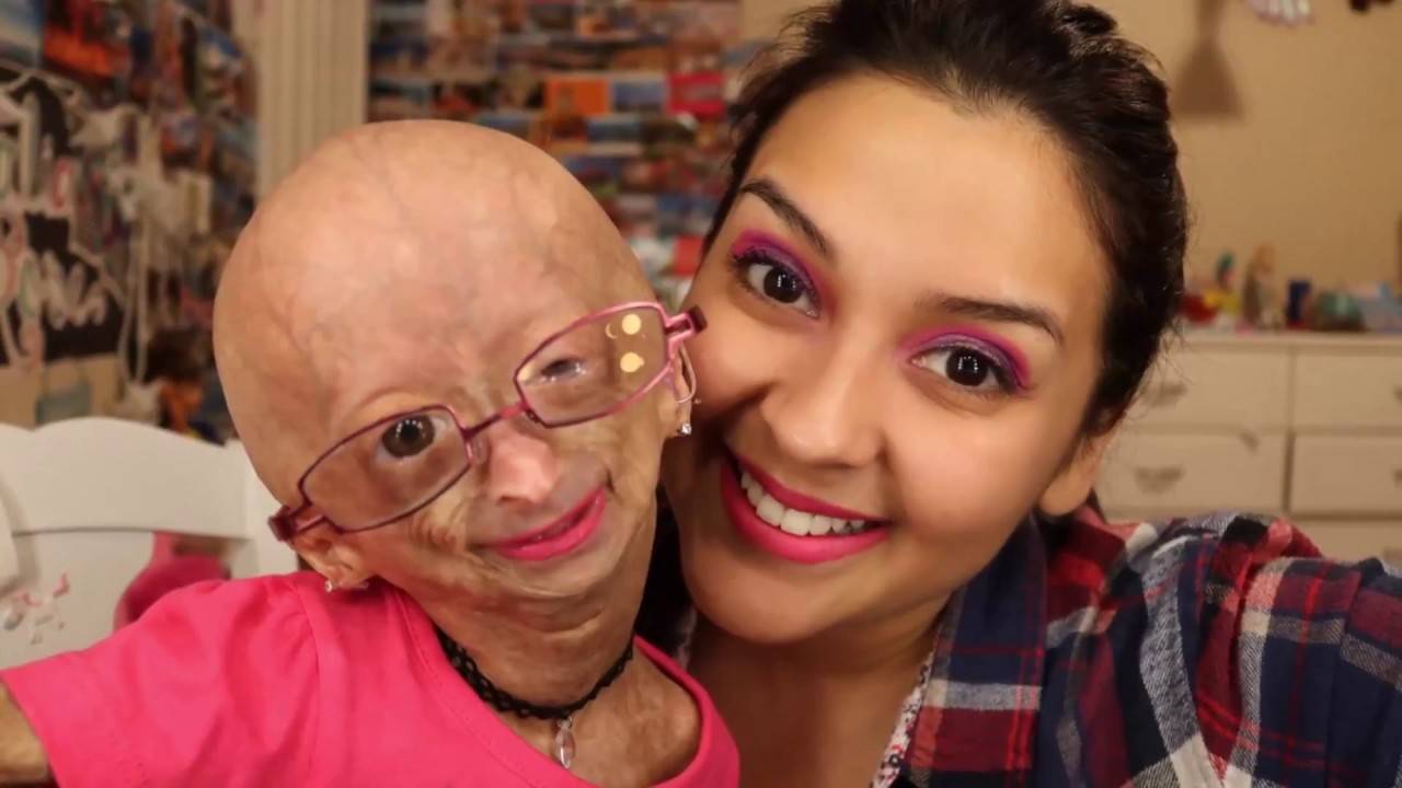 Adalia Rose, Idap Penyakit Progeria tapi Eksis di Social Media