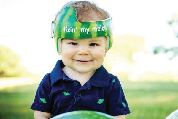 Helm Khusus untuk Bayi yang Memiliki Kepala Datar