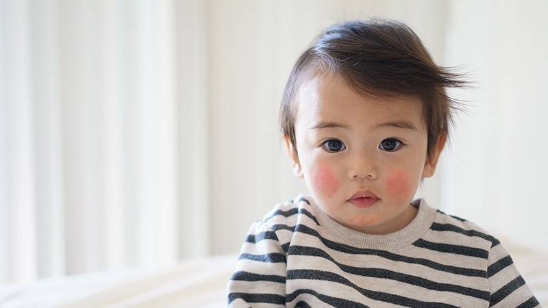 4 Cara Bersahabat dengan Dermatitis Atopik pada Bayi