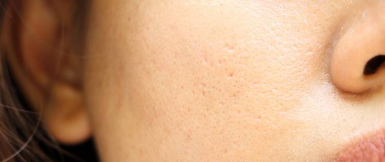 5 Kandungan Skincare Wajib Untuk Pori-pori Bersih dan Kencang