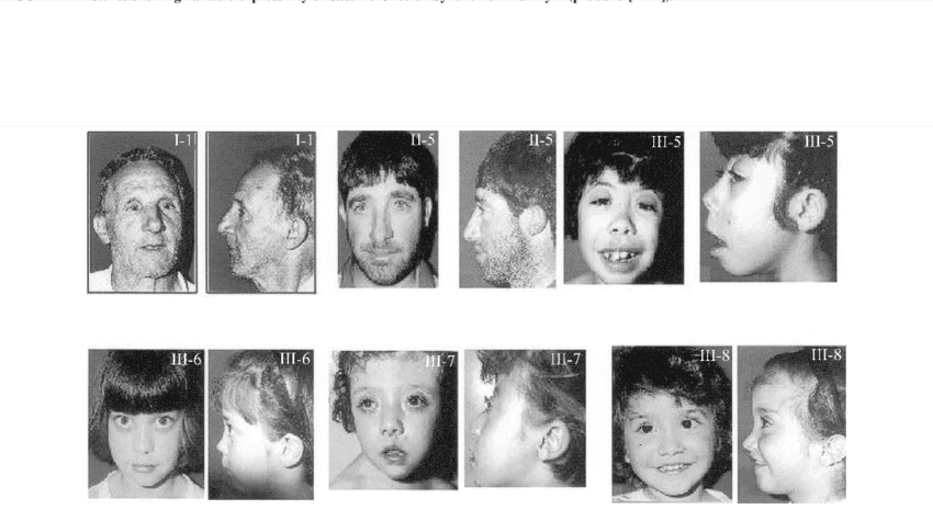 Sindrom Saethre-Chotzen, Ketika Bentuk Kepala dan Wajah Anak Mengalami Kelainan
