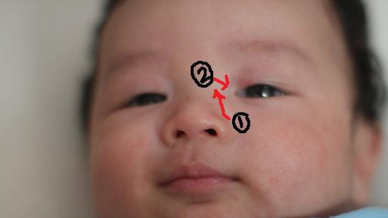 Obat sakit mata anak belekan
