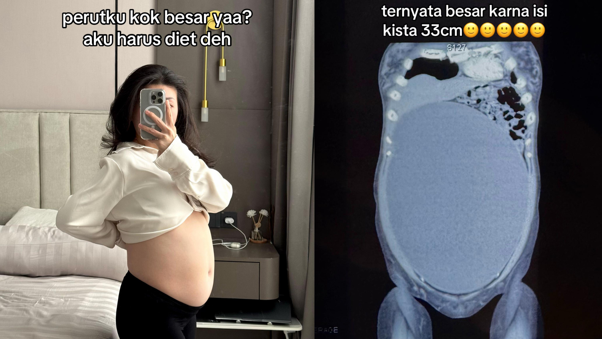 Dikira Perut Buncit, Ternyata Kista 33 cm! Kenali Penyebab dan Gejalanya