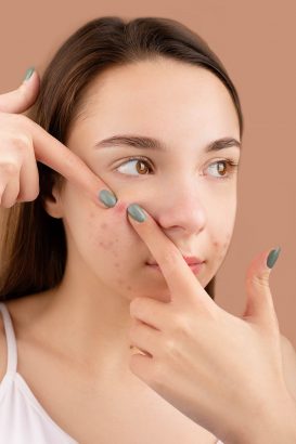 Jerawat Remaja Tak Kunjung Hilang? 8 Kebiasaan Ini Bisa Jadi Penyebabnya