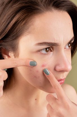 Kesalahan yang Bikin Bekas Jerawat Makin Susah Hilang