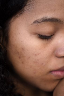 Kulit Kering tapi Berjerawat, Apakah Tetap Boleh Pakai Moisturizer?